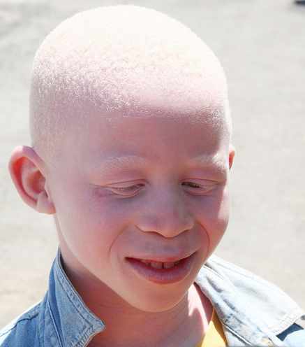 albinizm